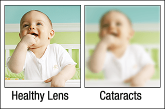 Cataracts Orlando Cataract before and after
