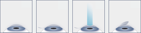 LASIK steps diagram