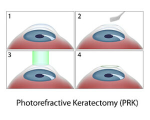 prk eye surgery diagram